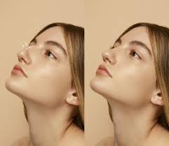 Is Getting a Nose Job in Dubai the Right Decision for You